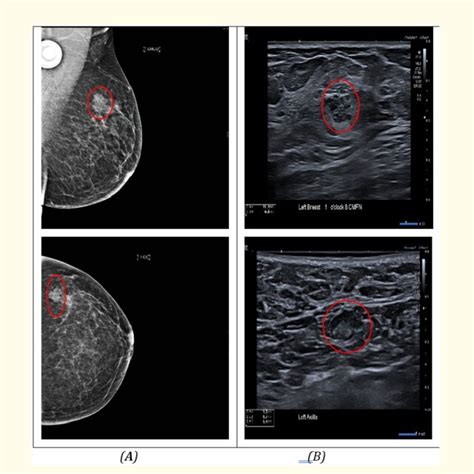 Breast Mri Showing Three Left Upper Outer Quadrant Enhancing Lesions