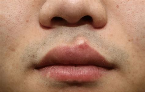 Epidermal Cyst On Upper Lip Download Scientific Diagram