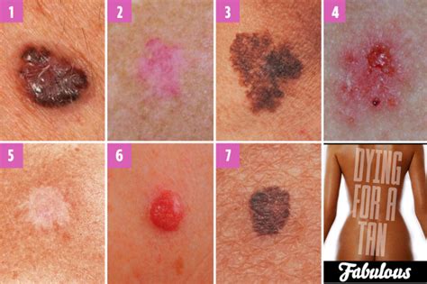 Spot On Can You Spot Which Moles Are Deadly The Skin Freedoms Phoenix
