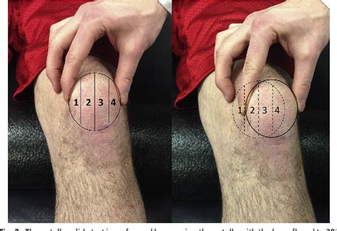 Figure 1 From Physical Examination Of The Patellofemoral Joint