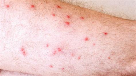 Eczema Bumps On Legs Dorothee Padraig South West Skin Health Care