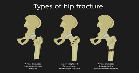 Don't Delay Hip Fracture Surgery. Here's Why - Comprehensive Orthopaedics