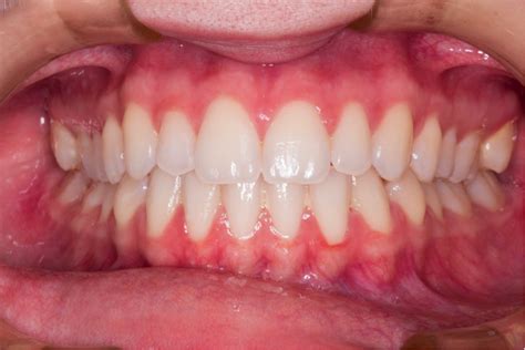 White Spots On Gums From Smoking