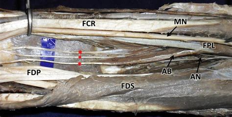If your reported income in 2018 is above 400% fpl ($48,240 for a single person), there is no cap on the premium subsidy payback. Dissection of flexor compartment of the right forearm ...