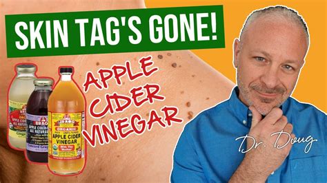 Skin Tag Solution Apple Cider Vinegar Youtube