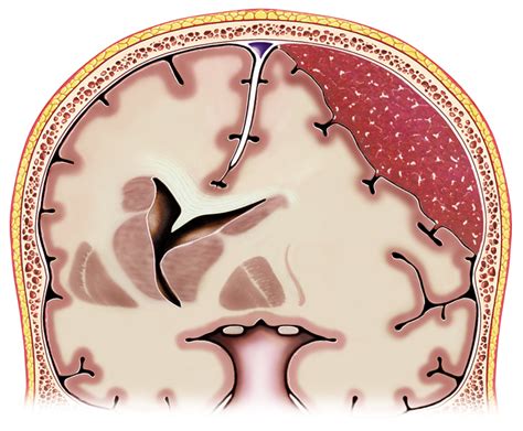 Hematomas Cerebrales Subdural Hematoma Brain Tissue Anatomy The Best