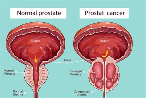 Normal Prostate And Acute Prostatitis Medical Illustration Stock