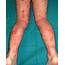 Management Of Difficult And Severe Eczema In Childhood  The BMJ