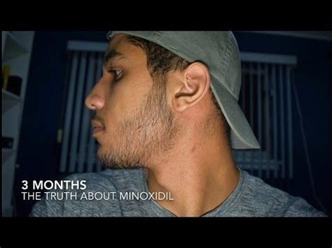 Real minoxidil testimonial for 15% minoxidil products. Minoxidil Side Effects: Results & The Truth of Minoxidil Beard Growth (3 Months) | IHazADream ...