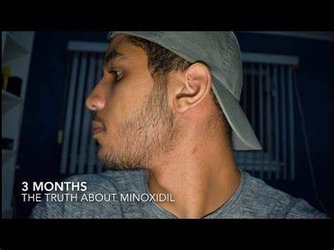 20 finasteride and minoxidil before and after results of starting with nw2 to nw5/6! Minoxidil Side Effects: Results & The Truth of Minoxidil Beard Growth (3 Months) | IHazADream ...