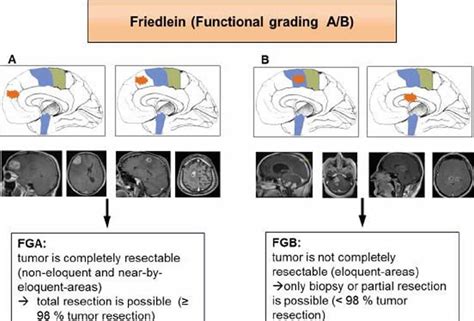 New Classification System For Brain Tumors Neuroscience News