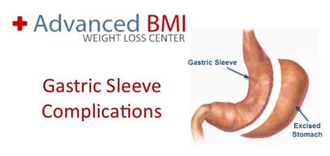 Gastric Sleeve Complications In Lebanon Dr Nagi Jean Safa