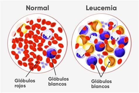 Leucemia Tipos Causas Y Tratamiento Tua Saúde