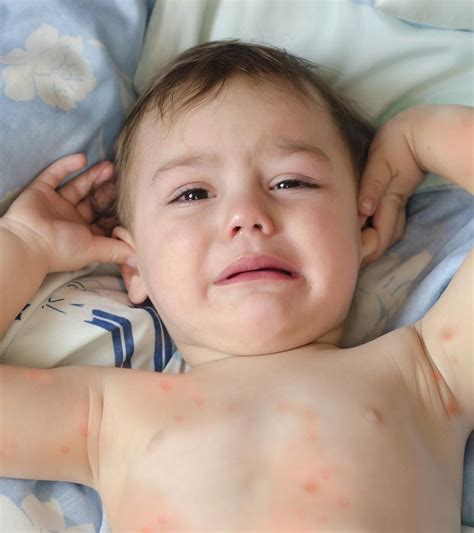 Spider Bites In Toddlers Facts Symptoms And Ways To Prevent