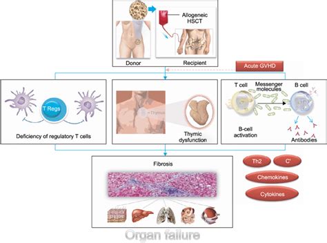 In the united states, over 20,000 patients per year receive allogenic hematopoietic stem cell transplantation (ahsct) as a cure for hematological disorders. The pathophysiology of chronic graft-versus-host disease ...