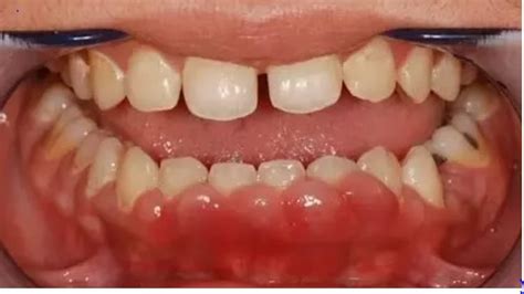 Causes And Treatments For Soft Painless Lump On Gum
