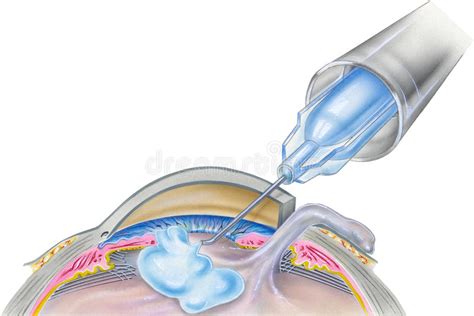 Two different options for cataract surgery. Eye - Cataract Surgery Step 3 Stock Illustration ...