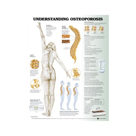 Anatomical Chart Understanding Osteoporosis Chart