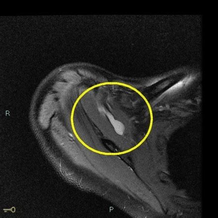 Intramuscular Ganglion Cyst Radiology Case Radiopaedia Org