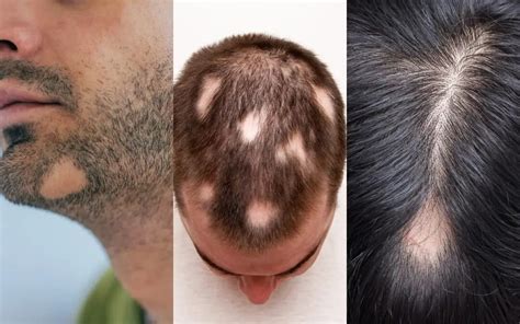 Alopecia Areata Circular Or Patchy Hair Loss