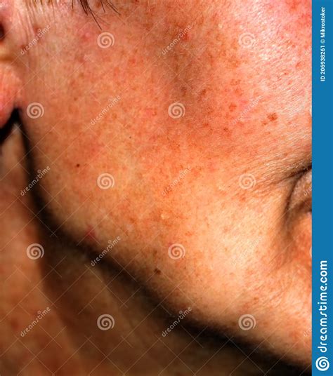Pigmentation On Cheek Brown Spots On The Skin Stock Image Image Of