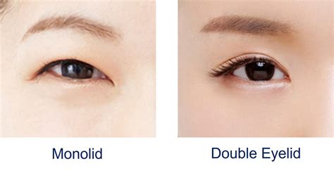 Ideal Candidate Guide For Double Eyelid Surgery In Singapore