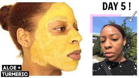 I Used An Aloe Vera Turmeric Face Mask For 5 DAYS THIS HAPPENED