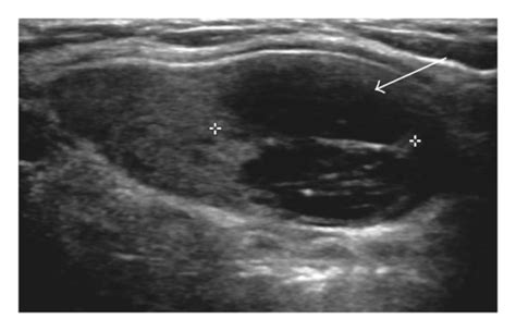 Four Years Later Image Of The Left Thyroid Nodule A In Transverse