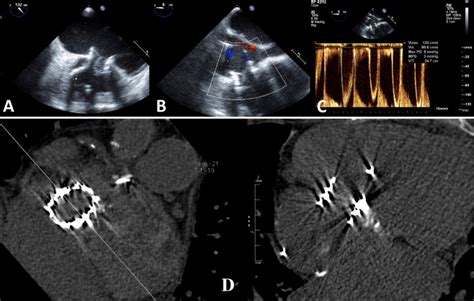 Ac Predischarge Echocardiography After Tricuspid Valve In Ring