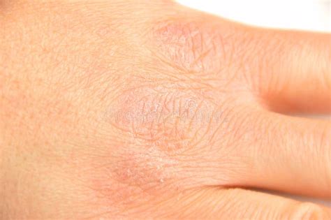 Hand With Very Dry Skin Stock Image Image Of Flaky 101994657