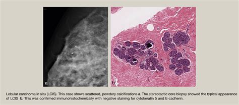Benign Microcalcification And Its Differential Diagnosis In Breast