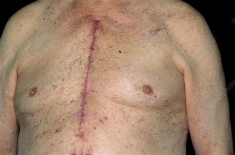 Heart Transplant Surgery Scar