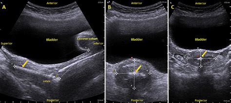 Figure 1 From Comparison Of Measurements Of The Uterus And Cervix Obtained By Magnetic Resonance