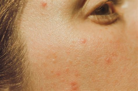 What Are The Different Types Of Acne Dermatologists Explain All