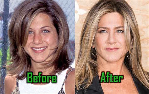 Jennifer Aniston Plastic Surgery Alters Her Nose Before After Photos