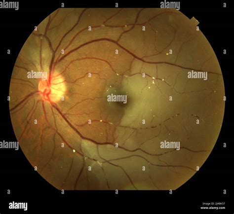 Hemispheric Retinal Artery Occlusion Fundoscopy Stock Photo Alamy