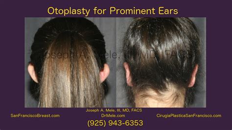 Otoplasty Cosmetic Ear Surgery And Ear Pinning San Francisco Bay Area