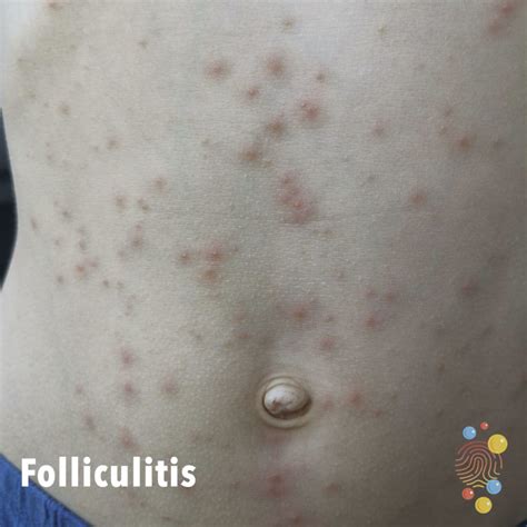 Folliculitis Skin Deep