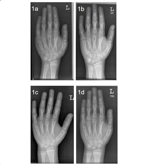 A Patient 1 Hand And Wrist Radiography 9y Accelerated Bone