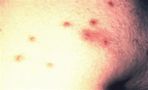 Hiv Rash Pictures What Does Hiv Rash Look Like How Is It Otosection