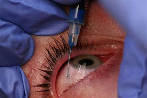 Controversy Confusion Reins Over Eye Injection Guidelines Insight