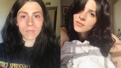 Before And After Perioral Dermatitis
