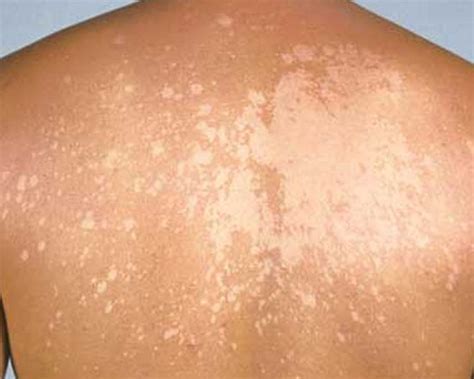 Tinea Versicolor Current Health Advice Health Blog Articles And Tips
