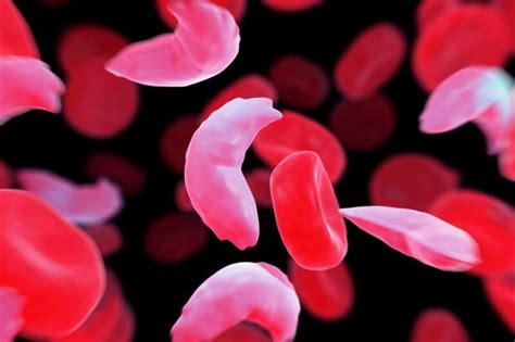 Care guide for sickle cell disease. Podcast: Has sickle cell disease met its match in CRISPR ...