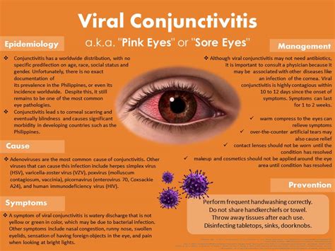 What Is Viral Conjunctivitis Aka Sore Eyes National