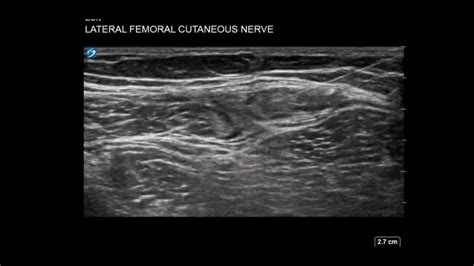 Thigh Ultrasound Lateral Femoral Cutaneous Nerve Lfcn Block Youtube