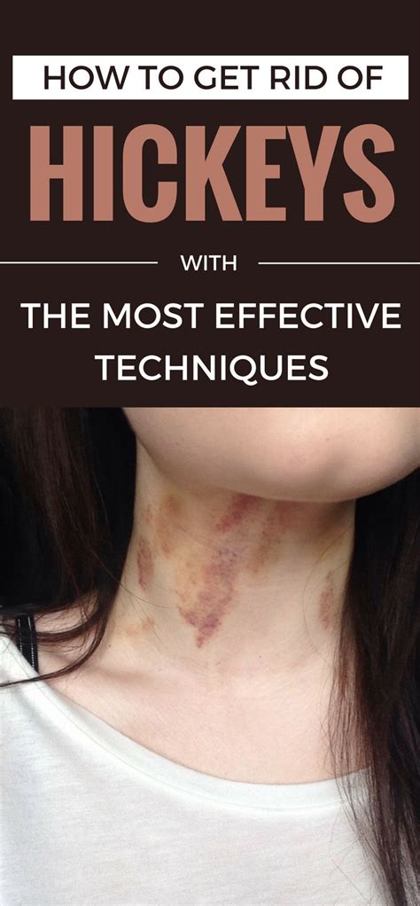 How To Get Rid Of Hickeys With The Most Effective Techniques Hickeys