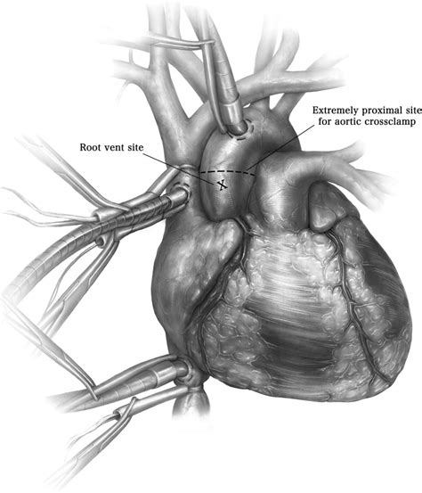 The Syncardia Total Artificial Heart Implantation Technique