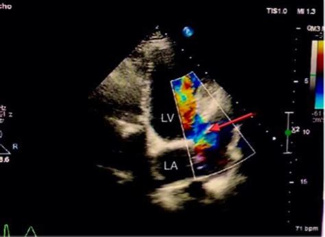 A Pregnant Woman With An Extra Cardiac Cavity An Acquired Iatrogenic Complication— A Case