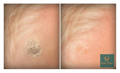 Wart And Verruca Removal Glasgow Laser Treatment Clinic Scotland